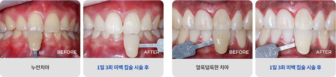 1일 3회 미백 집중 시술 변화 사진