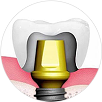 기성 지대주 임플란트