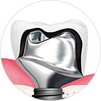 지대주 임플란트