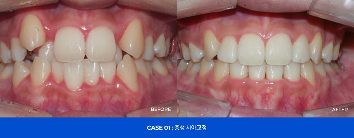CASE 01 : 총생 치아교정