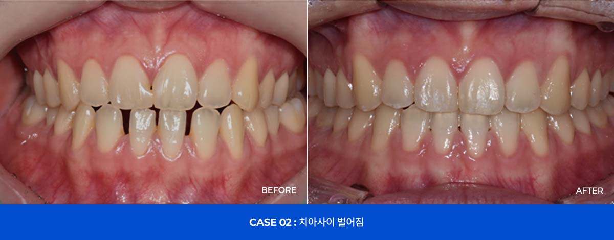 CASE 02 : 치아사이 벌어짐