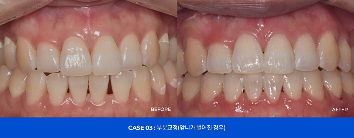 CASE 03 : 부분교정(앞니가 벌어진 경우)