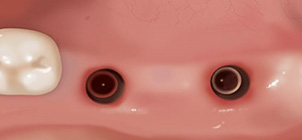 잇몸 절개 시술 사진