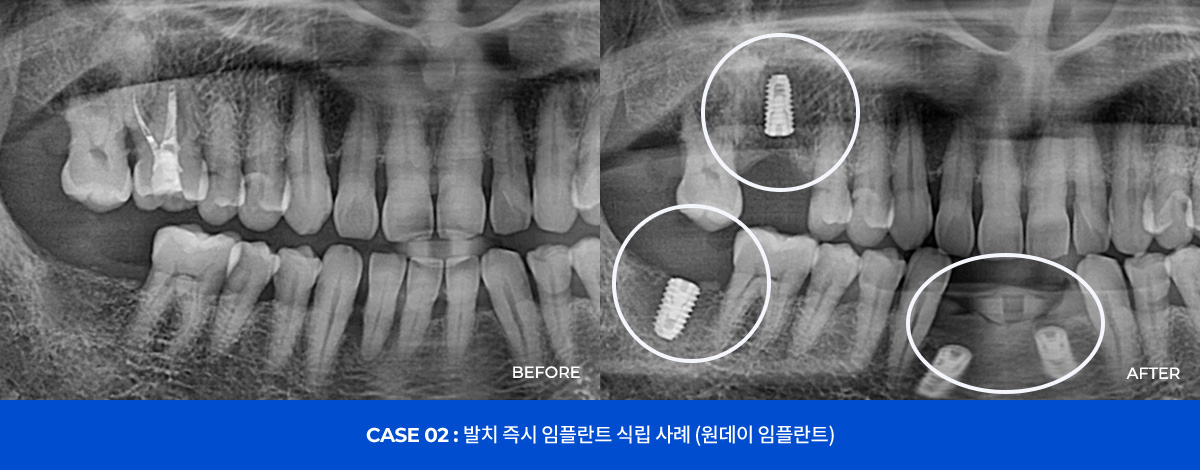 CASE 02 : 발치 즉시 임플란트 식립 사례 (원데이 임플란트)