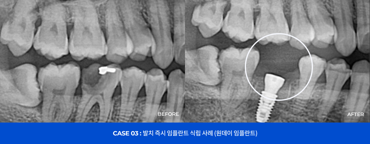 CASE 03 : 발치 즉시 임플란트 식립 사례 (원데이 임플란트)